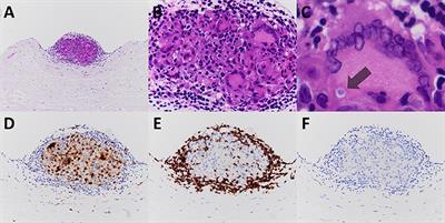 Case Report: Isolated and Focal Non-necrotizing Granulomatous Inflammation of Mitral Valves: A Report of Two Cases